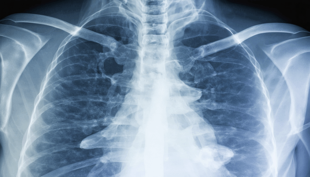 découvrez les aspects essentiels à contrôler concernant les poumons des fumeurs, ainsi que les signes d'alerte à ne pas négliger. informez-vous sur les implications de la radio pulmonaire et les étapes à suivre pour préserver votre santé respiratoire.