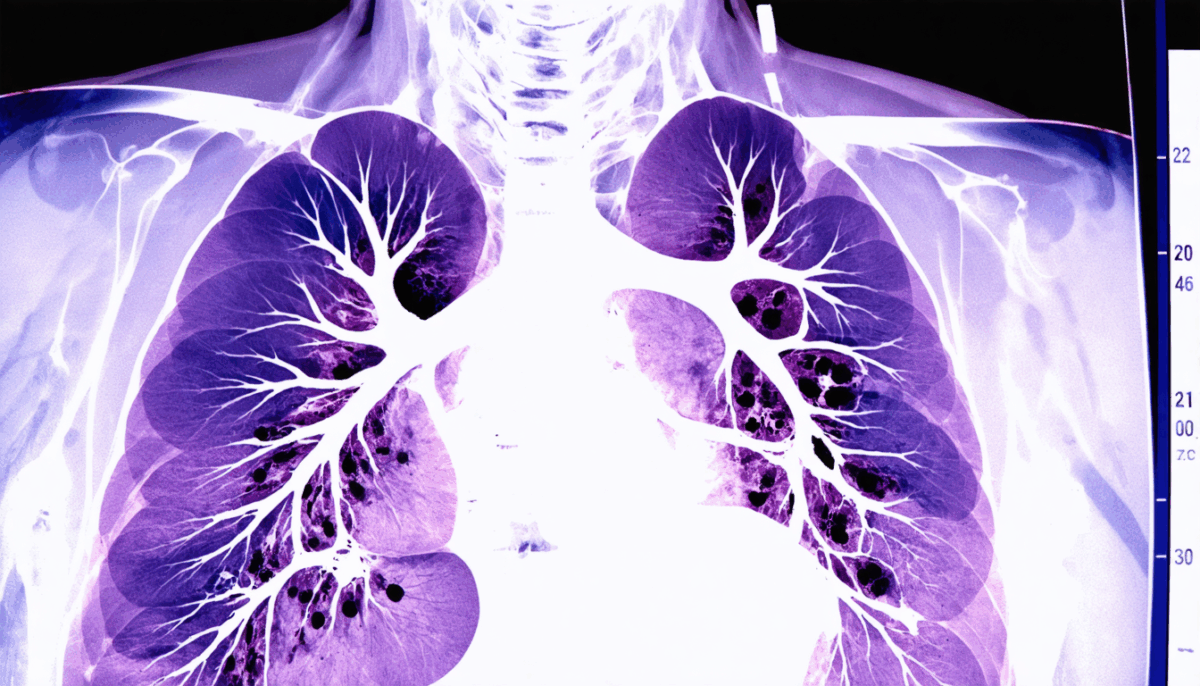 découvrez si vivre avec des nodules pulmonaires est possible. informez-vous sur les causes, les traitements et les précautions à prendre pour maintenir une bonne santé respiratoire malgré cette condition.