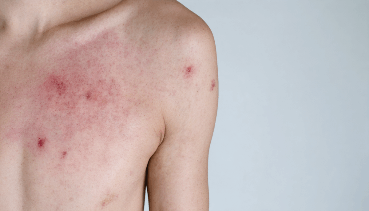 Allergies à la lessive : repérez les signes et apaisez votre peau